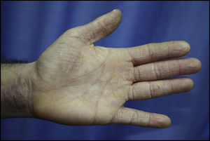 Chronic hyperkeratotic eczema affecting the palm, palmar surface of the fingers, and anterior surface of the wrist in a hairdresser with positive results to paraphenylenediamine and thiuram in patch tests.