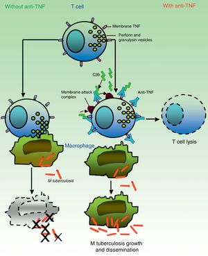 In absence of anti-TNF, cytotoxic effector memory T cells (TEMRA) release granulomas with cytolytic enzymes (perforin, granulysin) that destroy macrophages infected by M tuberculosis as well as intra- and extracellular bacilli. In presence of anti-TNF, transmembrane TNF of TEMRA is bound to this antibody, favoring lymphocyte apoptosis. Depletion of cytotoxic T cells therefore prevents growth control and allows dissemination of M tuberculosis. Source: Adapted from Miller and Ernst.41