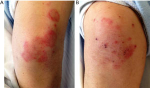 (a,b) Physical examination revealed well-defined erythematous annular plaques, located symmetrically on knees arranged in an annulare shape.