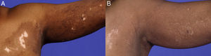 Área con hipo- e hiperpigmentación en región superior del torso y brazo A) como presentación inicial B) y pigmentada en el 90% con tratamiento con valaciclovir.