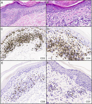 Infiltrado linfoide dérmico atípico para las células CD4+y CD8+con epidermotropismo focal; los estudios inmunohistoquímicos realizados confirmaron presencia de células T CD3+en dermis y epidermis con predominancia de células CD4 sobre células CD8 en la dermis, en una proporción CD4:CD8 de, aproximadamente, 4:1. En la epidermis, se observó un subgrupo de linfocitos atípicos negativos para CD4 y CD8. Hay pérdida de expresión de CD7. Pocas células fueron reactivas al marcador CD30. La mayoría de los linfocitos dieron positivo para el receptor de la cadena beta de linfocitos T (BF1) y negativo para el receptor de la cadena gamma de linfocitos T. A) Tinción hematoxilina y eosina, 40x. B) Tinción hematoxilina y eosina, 200x C-F) inmunohistoquímica, 200x.