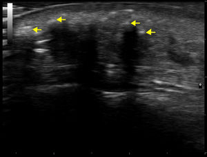 Skin ultrasound (M-mode, 18MHz) image showing hyperechoic lesions (yellow arrows) with posterior acoustic shadow in the subcutaneous cellular tissue compatible with calcinosis.