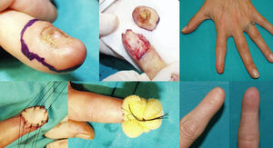 Case 1. Functional surgery with wide local excision of the nail unit in a patient with amelanotic subungual melanoma in situ and complete onychodystrophy of the left index finger. Results after 2 years.