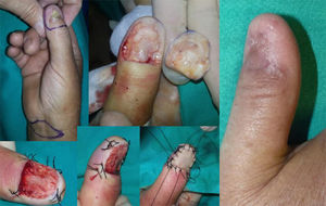Case 10. Functional surgery with wide local excision of the nail unit in a patient with a moderately differentiated subungual squamous cell carcinoma with a thickness of 4mm and extensive onychodystrophy of the right thumb. Result after 6 months.