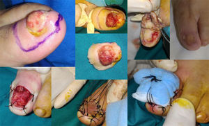 Case 11. Functional surgery with wide local excision of the nail unit in a patient with a moderately differentiated subungual squamous cell carcinoma with a thickness of 6mm on the first toe of the left foot. Note the excrescent tumor in the area of the onychodystrophy. Result after 4 months.