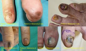 Photographs of the 7 subungual melanomas in our series.