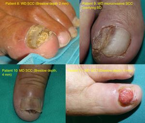Photographs of the 4 subungual SCCs. MD indicates moderately differentiated; SCC, squamous cell carcinoma; WD, well-differentiated.