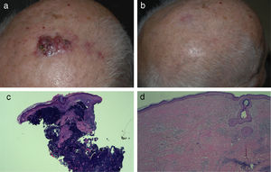 Patient 1. A, Clinical image of Merkel cell carcinoma on the scalp. B, Appearance of scalp after regression of the lesions. C, Histologic image of initial biopsy of the scalp tumor showing a dense dermal proliferation of basophilic cells (hematoxylin-eosin, original magnification×40). D, Histologic image of biopsy of scalp tumor after regression, showing only residual fibrosis and a mild chronic inflammatory infiltrate (hematoxylin-eosin, original magnification×100).