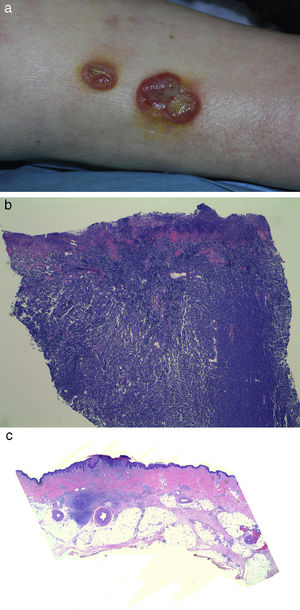 Case 2. A, Clinical image of Merkel cell carcinoma in pretibial region showing 2 ulcerated tumors. B, Histologic image of initial biopsy from 1 of the tumors showing a dense dermal proliferation of basophilic cells (hematoxylin-eosin, original magnification×40). C, Histologic low-magnification detail of 1 of the pretibial tumors after regression, showing intense residual fibrosis and a lymphocytic infiltrate. Biopsy showed just a tumor nest measuring 2.5mm and formed by basophilic cells at the base of the proximal ulcer (hematoxylin-eosin, original magnification×20).