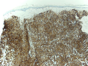 Inmunohistochemistry (CD56), original magnification ×20.