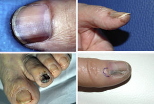 Example of 4 patients with subungual melanoma presenting with longitudinal melanonychia at diagnosis at our dermatology department.
