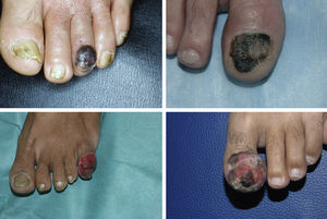 Example of 4 patients with subungual melanoma with advanced-stage lesions at diagnosis at our dermatology department.