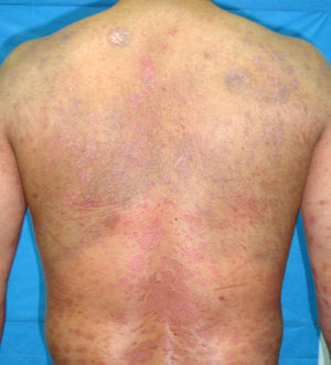 Bluish-gray macules with a patchy distribution. The colors can only be distinguished in the electronic version of this article.