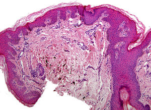Epidermis with acanthosis and papillomatosis (hematoxylin-eosin, original magnification ×50). Note the spindle cells containing melanin pigment among the collagen bundles in the mid dermis.