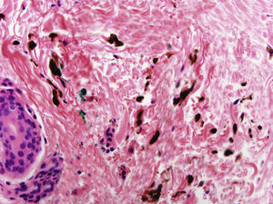 Spindle melanocytes with abundant melanin pigment scattered among the collagen bundles.