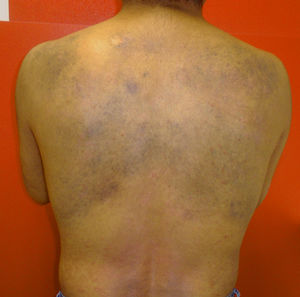 Bluish-gray macules with greater pigmentation and extension. The colors can only be distinguished in the electronic version of this article.