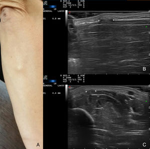 A, Nodule on the ulnar side of the right forearm. B and C, B-mode ultrasonography: discontinuity of the muscle fascia can be seen between the markers. B, Longitudinal view. C, Transverse view.