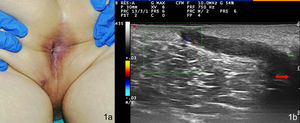 Clinical and ultrasound image of the first patient. A,Violaceous nodule on the left side of the perineum, showing the central orifice. B,Hypoechoic band corresponding to the fistular path, which connects the dermis below the lesion to the anal canal (red arrow).