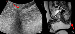 Confirmed diagnosis of primary cryptogenic perianal fistula and detail of the fistular path (red arrow) in transcutaneous perianal ultrasound (A) and magnetic resonance imaging (B).