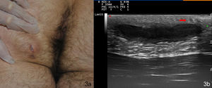 Clinical and ultrasound images of the first patient. A,Violaceous nodules with an erosive central region on the left buttock. B,Hypoechoic subcutaneous band corresponding to the fistular path, which connects the visible lesion with the perianal skin. Thickening of the dermis and dilated follicles can also be seen (red arrow).