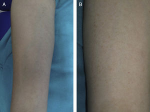 A, Multiple papules of several millimeters in diameter located on the ventral forearm. B, More detailed image showing the erythematous-brownish coloration and monomorphic appearance of the lesions.