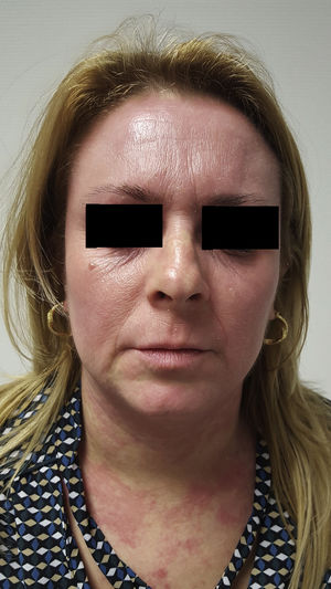 Erythema and edema on the face and neck at the initiation of treatment with itraconazole.