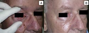 Man aged 73 years with sclerodermiform basal cell carcinoma measuring 3×3cm on the medial canthus (A). A partial response was observed after 6 months of treatment (B) (patient 6 in Table 1).