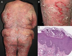 (A-B) Erythrodermic psoriasis with generalized erythema, desquamation and pustules. (C) Histopathology reveals parakeratosis, acanthosis, hypogranulosis and a subcorneal pustule (H&E, original magnification x20).