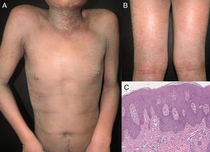 (A-B) Erythrodermic atopic dermatitis with generalized erythema, fine scale and increased severity in flexural creases. (C) Histopathology reveals parakeratosis, acanthosis and mild spongiosis (H&E, original magnification x20).