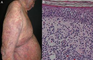 (A) Erythrodermic micosis fungoides. (B) Histopathology reveals epidermotropism of atypical lymphocytes, Pautrier's microabscesses and dermal infiltration of neoplasic cells (H&E, original magnification x40).