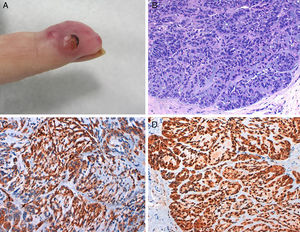 A, Painful erythematous plaque on the finger containing several superficial nodules and papules, some of which are eroded. B, Proliferation of small cells with round, hyperchromatic nuclei with scant eosinophilic cytoplasm forming cords immersed in a basophilic matrix. Some mitotic figures are observed. There are no areas of squamous differentiation. C, Actin staining showing strong cytoplasmic positivity. D, S-100 staining showing strong cytoplasmic positivity.