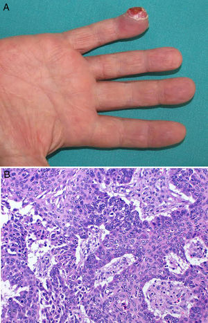 A, Erythematous-pink tumor on the pulp of the little finger of the right hand containing several keratotic areas. B, Dermal proliferation of neoplastic cells with an epithelial appearance, abundant mitotic figures, and nuclear atypia.