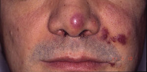 Kaposi sarcoma in a patient with acquired immunodeficiency syndrome. Erythematous-violaceous plaques on the tip of the nose, corner of the mouth, and left cheek.