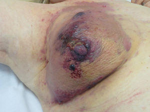 Angiosarcoma. Reddish-violaceous papules and nodules on an erythematous-violaceous plaque on a breast previous irradiated for cancer.