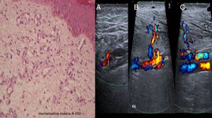 On the left, a histologic image showing the proliferation of capillaries in the deep dermis and papillary dermis, fibrosis, extravasated red blood cells, hemosiderin deposits, and tortuous vessels. On the right, Doppler ultrasound images showing an arteriovenous fistula of the posterior tibial artery (A), anterior tibial artery (B), and arterialized venous flow distal to the anterior tibial vein (C).
