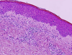 Normal epidermis and dense perivascular lymphocytic infiltrate with abundant eosinophils. Preserved dermoepidermal junction (hematoxylin-eosin, original magnification ×20).