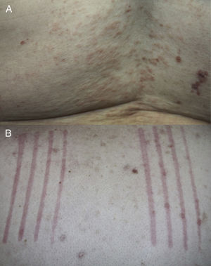 A, Excoriated erythematous papules on the back of a patient. B, Use of the Fric test to confirm dermographism on the back of a patient with prurigo lesions at different stages of progression.
