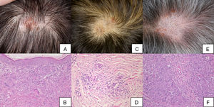 Clinical and histological characteristics of scalp sarcoidosis (hematoxylin-eosin staining, original magnification ×200). A and B, Case 1. C and D, Case 2. E and F, Case 3.