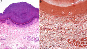 A, Compact orthokeratotic hyperkeratosis resting on a slight epidermal depression with hypergranulosis (hematoxylin-eosin, original magnification, ×10). B, Orcein staining, with no evidence of elastorrhexis or other dermal alterations (orcein, original magnification, ×20).