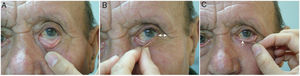 Examination of palpebral laxity. A, Snap test: slow repositioning of the eyelid. B, Medial traction: examination of lateral canthal laxity based on increase in the external angle. C, Lateral traction: assessment of medial canthal laxity based on the degree of movement of the tear duct.