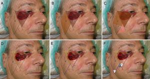 Design of the Mutaf triangular flap. A, Conversion of the primary defect into a triangle. B, Rotation of the second triangle required to cover the primary defect (arrow). C. Rotation of the third triangle required to cover the secondary defect (arrow). D, The first part of the flap is traced at the same distance as the upper line of the defect converted to a triangle (yellow dotted line). E, The length of the flap must be the same as that of the internal face of the defect (purple dotted line) it will be moved toward (arrow). F, Extension of the vertex of the defect to define the third triangle (red dotted line). Angles of the vertices of the 3 triangles.