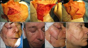 Mutaf triangular flap. A, Primary defect converted to a triangle. B, Raised flap made up of 3 opposing triangles. C, Final positioning of the flap. D and E, Immediate and later postoperative period (8 weeks). Front and side view.