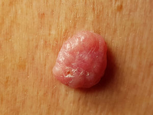Polypoid, nonulcerated, pearl-like tumor with superficial telangiectasia.