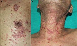 Cutaneous rash, elementary lesions.
