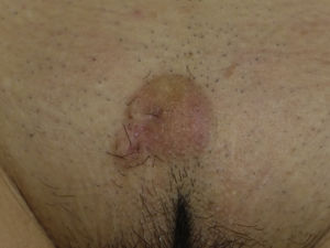 Cutaneous leiomyosarcoma on the pubis.