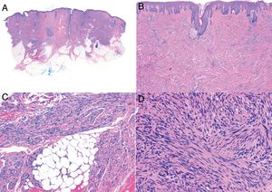 Characteristic histologic features of leiomyosarcoma. A, Panoramic view of a poorly circumscribed dermal tumor invading the subcutaneous tissue. B, Higher-magnification view showing interlacing fascicles of nonuniformly arranged spindle cells in the dermis reminiscent of muscle fibers. C, Invasion of subcutaneous tissue. D, Fascicles of pleomorphic spindle cells intersecting each other at a right angle; mitotic figures.