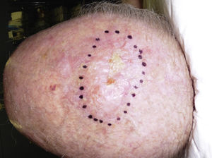 Pleomorphic dermal sarcoma on the scalp of an elderly patient. Poorly circumscribed tumor in the form of an indurated plaque.