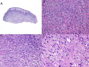 Histologic findings in a pleomorphic sarcoma. A, Panoramic view of a tumor invading the dermis and subcutaneous layer. B, Tumor formed by spindle cells arranged in a storiform pattern. C, Cells immersed in a myxoid stroma. D, Detail of several more pleomoprhic cells with a wide cytoplasm.