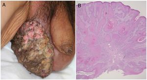 A, A giant, dark erythematous, indurated cauliflower-like mass on the scrotum. B, Biopsy of the mass showed squamous cell carcinoma (hematoxylin-eosin, original magnification ×40).