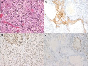 Histologic examination of the fully resected tumor showed undifferentiated atypical squamous cells with extravasation and multiple thrombi (A) (original magnification×200). The cells were positive for p40 (B) and AE1/AE3 (C) and negative for CD31 (D) (original magnification×100).